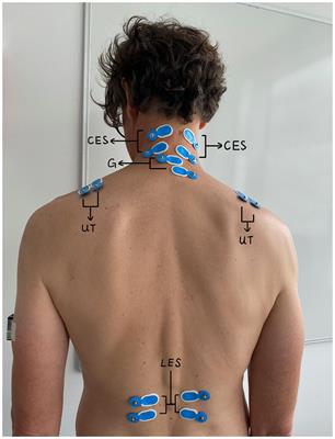 Ergonomics and performance of using prismatic loupes in simulated surgical tasks among surgeons – a randomized controlled, cross-over trial